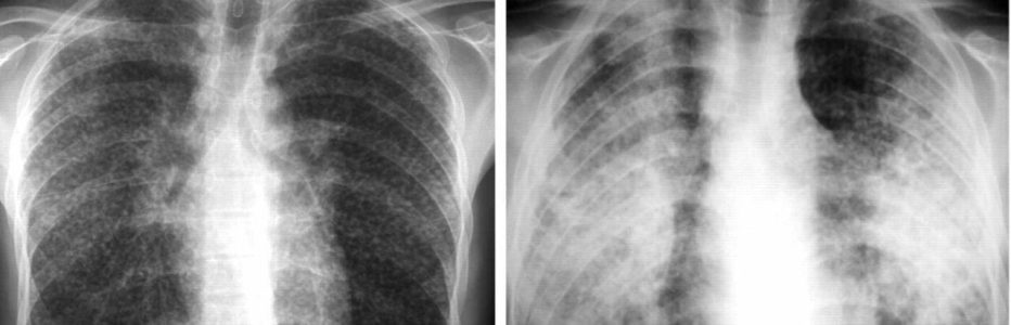 silicosis-xrays